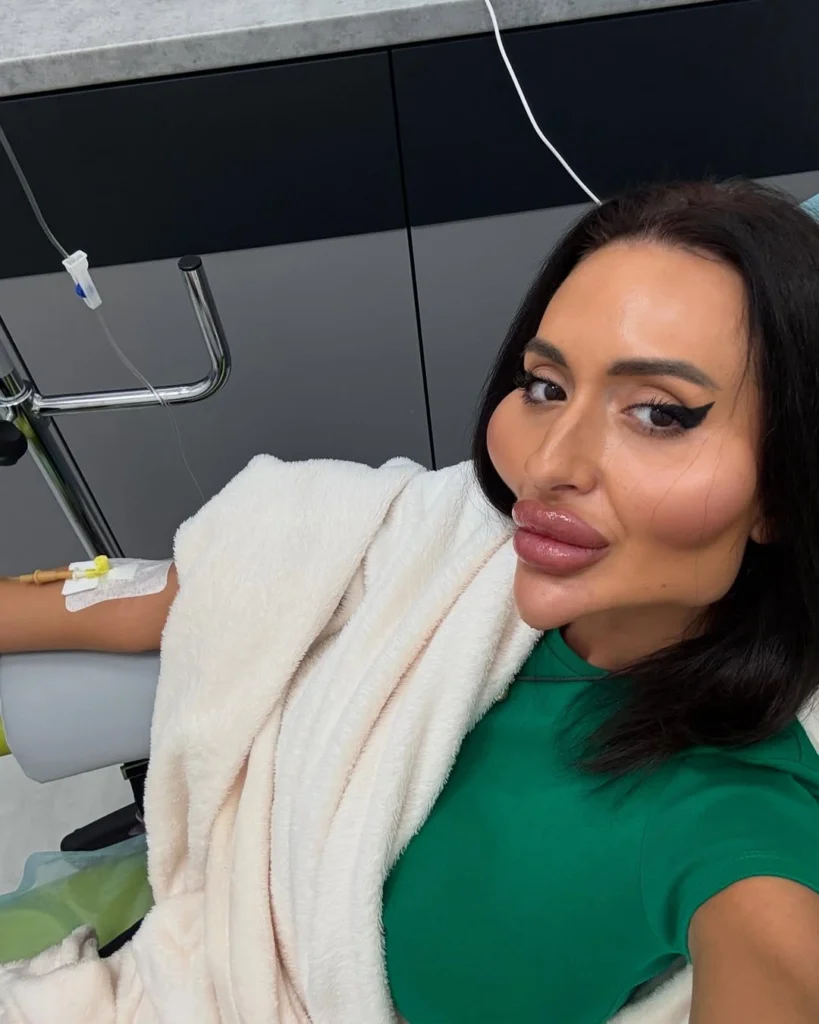 Woman With 'World’s Biggest Cheeks' Gets More Injections Administered To Look Dramatic